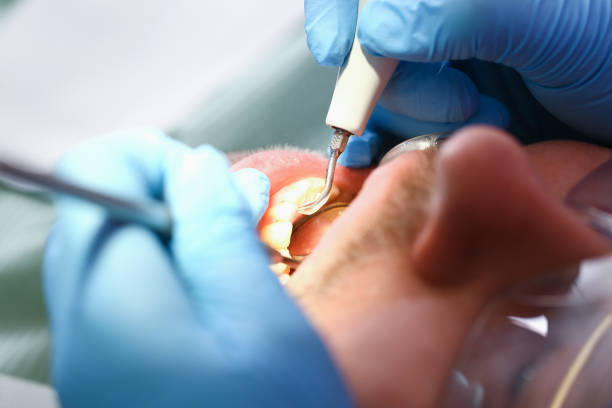 Best Emergency Treatment for Dental Infections or Abscesses in Suncrest, WA